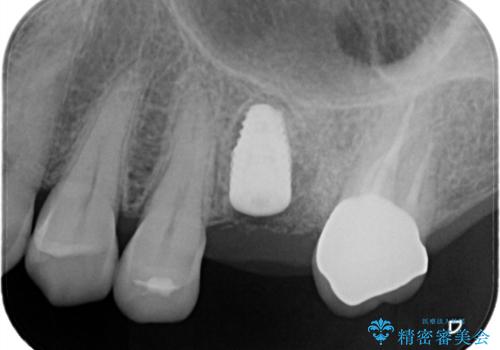 【歯牙破折】インプラントによる咬合回復の治療中