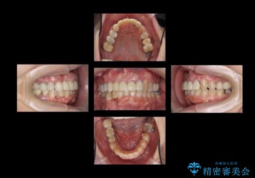 全体的な歯周病治療 包括治療の治療中