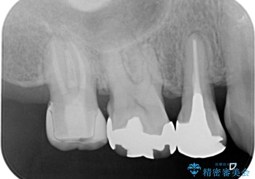 【オールセラミッククラウン】メタルフリー治療の治療前