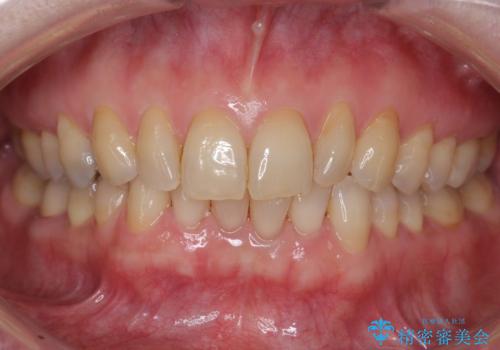 夜間の歯ぎしりを防ぐためのナイトガードの症例 治療前