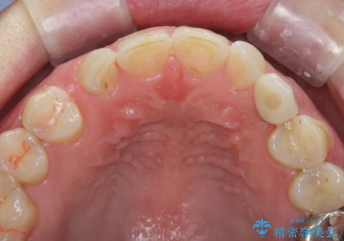 骨造成を伴う 前歯部インプラント治療の治療後