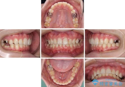 インビザラインによる矯正治療と奥歯のインプラント治療の治療中