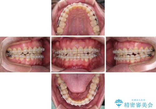 前歯でものを噛みきりたい 目立たない装置でのワイヤー矯正の治療中