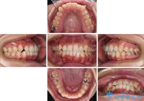 【モニター】カリエール・ディスタライザーを併用した八重歯のインビザライン矯正 の治療中