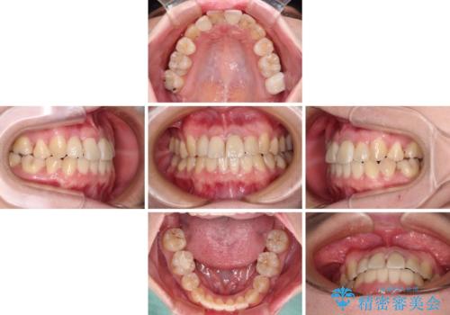 虫歯治療ついでに歯並びの後戻りを改善 インビザラインによる矯正治療の治療中