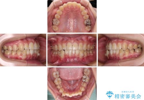 【モニター】下顎前歯のデコボコをインビザラインできれいにの治療中