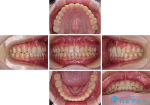 治療途中の奥歯と矯正治療の後戻り インビザライン・ライトによる矯正治療の治療中