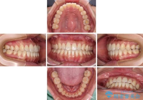 【モニター】前歯のデコボコをインビザラインで改善の治療中