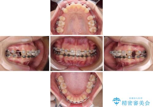 口が閉じられない ワイヤー装置での抜歯矯正の治療中