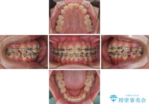 膨らんだ口元 ワイヤー装置での抜歯矯正の治療中