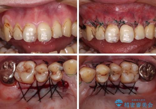 むし歯だらけの前歯をオールセラミッククラウンできれいにの治療中