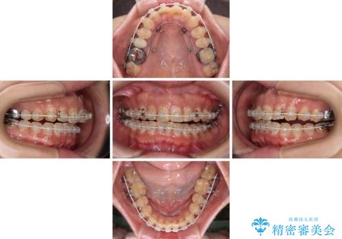 【モニター】飛び出た前歯を整えたい ワイヤー矯正治療の治療中