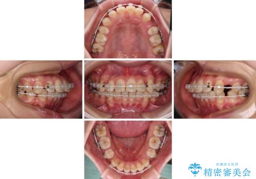 【モニター】口が閉じにくい 抜歯矯正で口元を引っ込めるの治療中