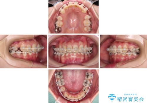 デコボコと深い咬み合わせ ワイヤー装置での抜歯矯正の治療中