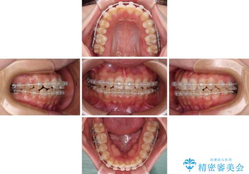 【モニター】短期間で終わりたい ワイヤー装置での非抜歯矯正の治療中