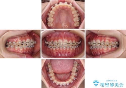 インビザラインは使える自信がない ワイヤー装置にて矯正治療の治療中