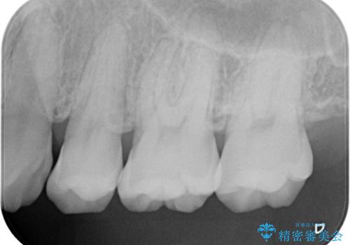 歯周病治療【オープンフラップ】の治療前