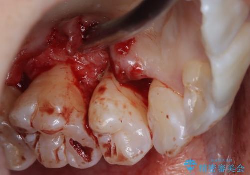 歯周病治療【オープンフラップ】の治療中