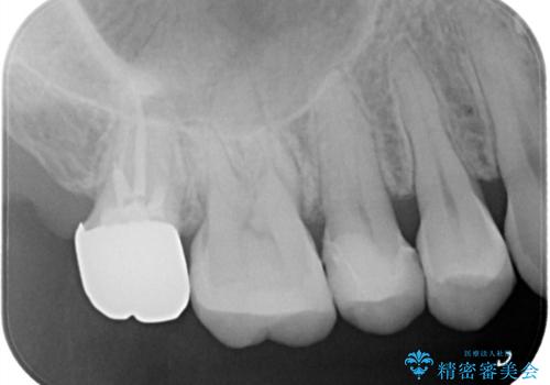 目立つ銀歯をセラミックに変えたい セラミックインレーの治療後