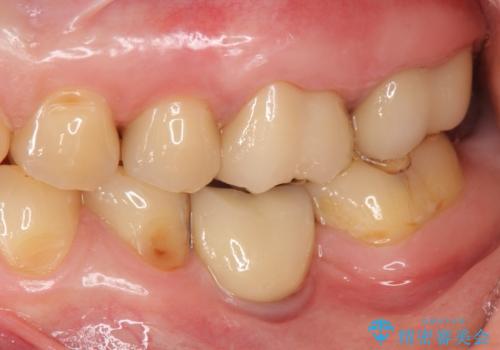 奥歯から臭いがする　銀歯下の虫歯再発の治療後