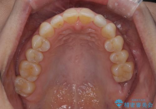 歯のすり減りと歯の挺出をナイトガードで予防の症例 治療前