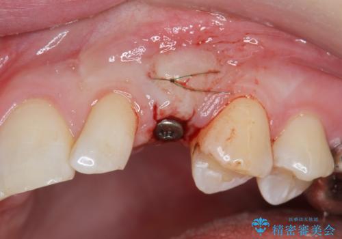 骨造成を伴う 前歯部インプラント治療の治療中