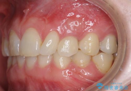 骨造成を伴う 前歯部インプラント治療の治療後