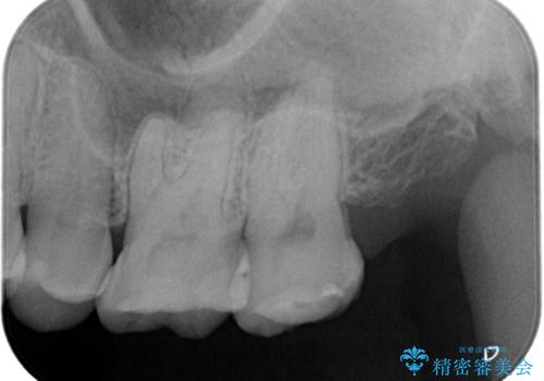 【セラミックインレー】適合の良いセラミックインレーを入れたい。の治療前