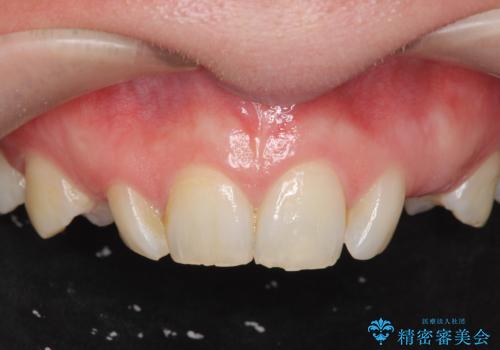 骨造成を伴う 前歯部インプラント治療の治療前