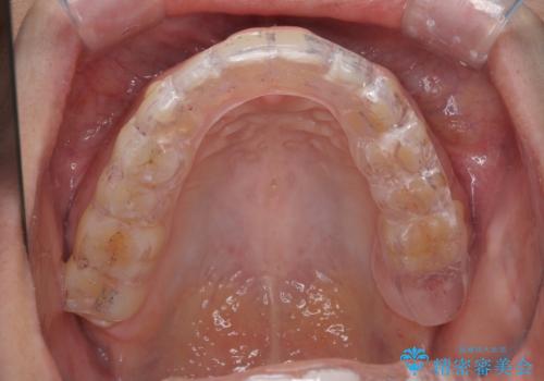 歯のすり減りと歯の挺出をナイトガードで予防の症例 治療後
