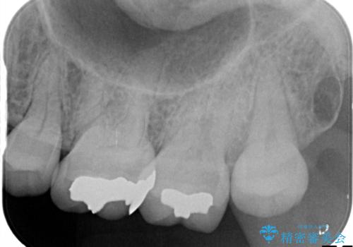 【セラミッククラウン】メタルフリー治療の治療前