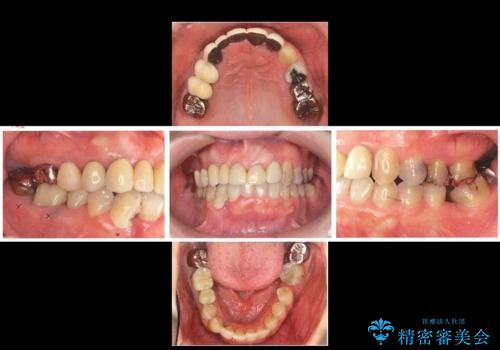 全体的な歯周病治療　包括治療の治療前