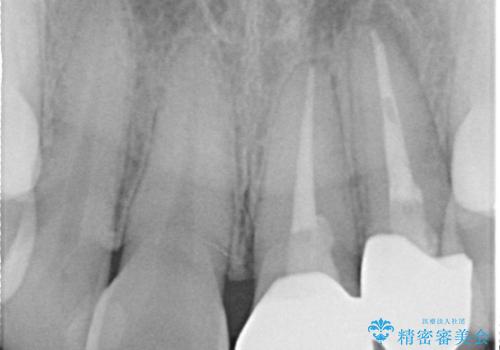 前歯の歯茎の黒ずみと被せ物の形と色が気になる【オールセラミッククラウン】の治療後