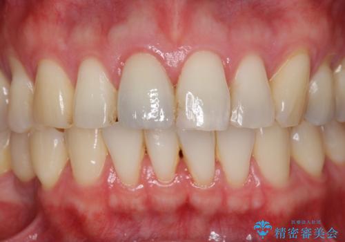 前歯の変色を改善!セラミック治療の治療後