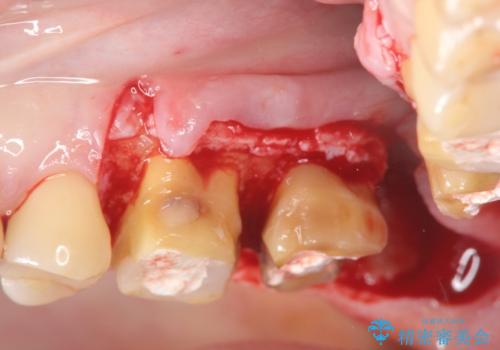 奥歯から臭いがする 銀歯下の虫歯再発の治療中
