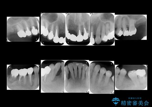 全体的な歯周病治療 包括治療の治療前