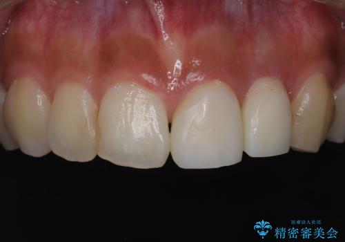前歯の歯茎の黒ずみと被せ物の形と色が気になる【オールセラミッククラウン】の治療中