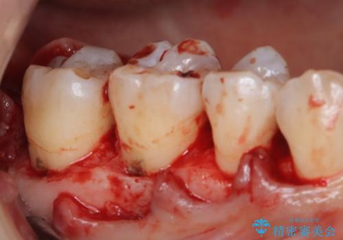 歯周病治療【オープンフラップ】の治療前