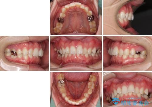 インビザラインによる矯正治療と奥歯のインプラント治療の治療前