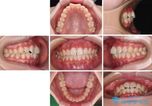 インビザラインは使える自信がない ワイヤー装置にて矯正治療の治療前