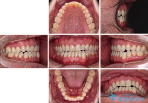 前歯でものを噛みきりたい 目立たない装置でのワイヤー矯正の治療前
