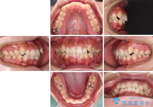 【モニター】カリエール・ディスタライザーを併用した八重歯のインビザライン矯正 の治療前