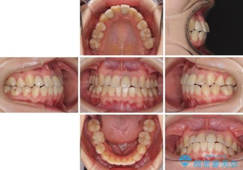 虫歯治療ついでに歯並びの後戻りを改善 インビザラインによる矯正治療の治療前
