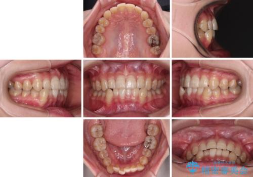 【モニター】下顎前歯のデコボコをインビザラインできれいにの治療前