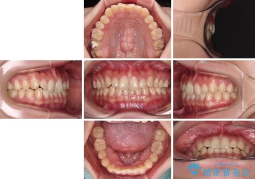 治療途中の奥歯と矯正治療の後戻り インビザライン・ライトによる矯正治療の治療前