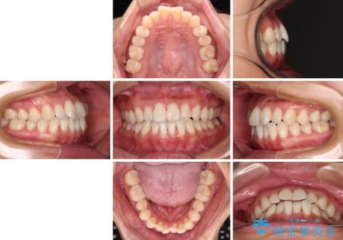 【モニター】前歯のデコボコをインビザラインで改善の治療前