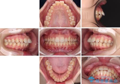 口が閉じられない ワイヤー装置での抜歯矯正の治療前