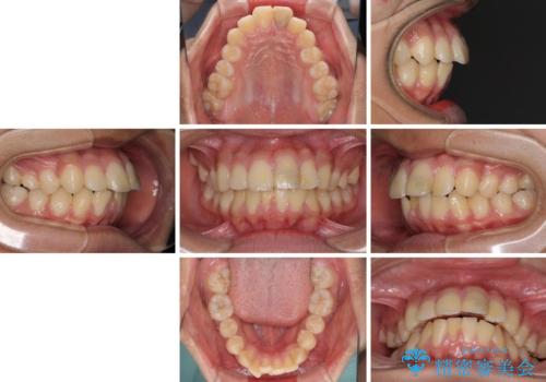 膨らんだ口元 ワイヤー装置での抜歯矯正の治療前