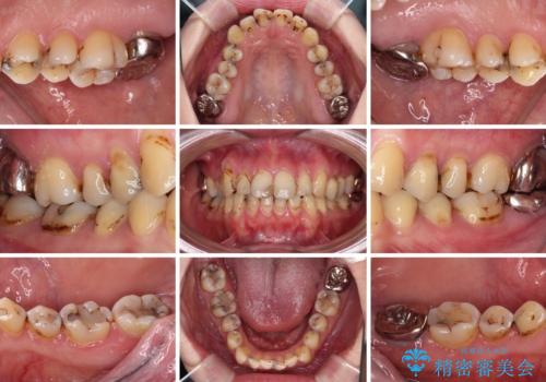 むし歯だらけの前歯をオールセラミッククラウンできれいにの治療前