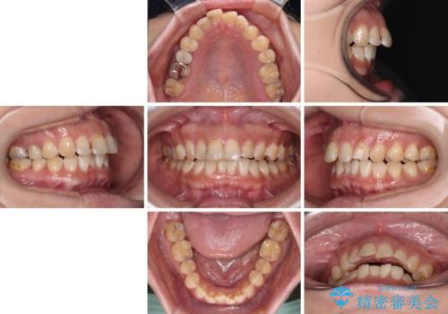 【モニター】飛び出た前歯を整えたい ワイヤー矯正治療の治療前
